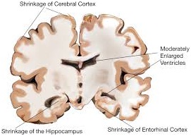 Moderate Alzheimer's disease 